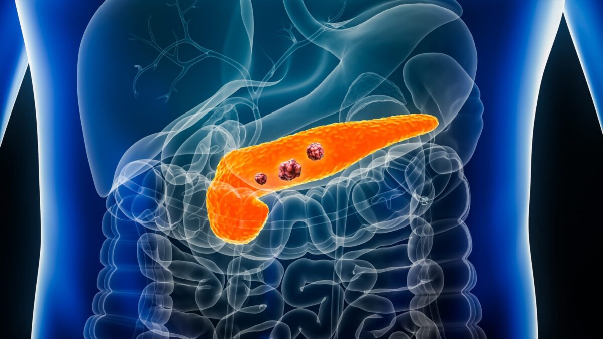 MIT Develop AI Model PRISM Which Detects Pancreatic Cancer Early 1 MIT Develop AI Model PRISM Which Detects Pancreatic Cancer Early